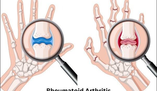 Rheumatoid Arthritis