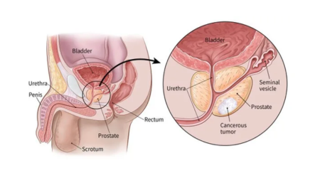 Prostate Prostate