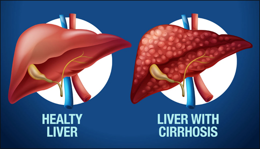 Cirrhosis of the Liver