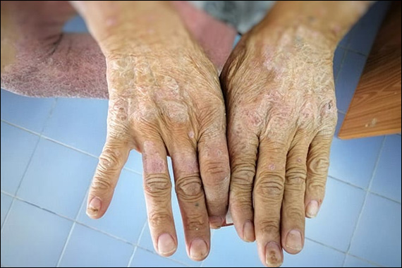Scleroderma, Autoimmune, Disease, Disorder