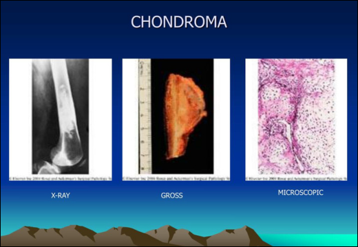 Chondroma Causes Chondroma Causes