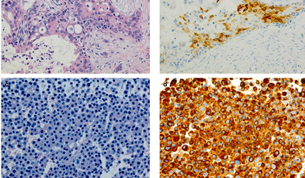 Acinic cell carcinoma