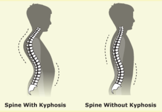 KYPHOSIS - HUNCHED BACK OR DOWAGER’S HUMP