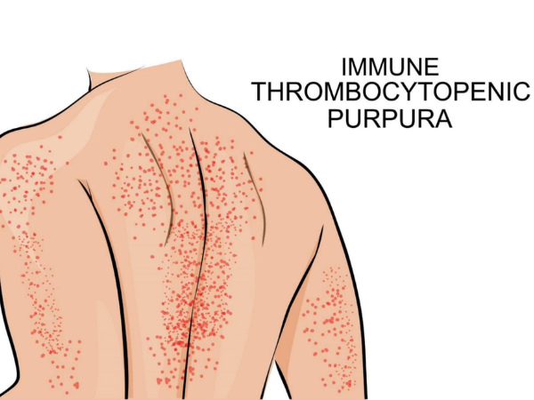 Immune Thrombocytopenia (ITP)