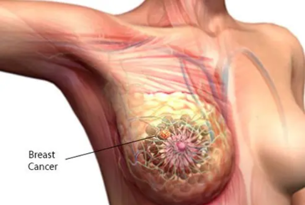The Genesis of Breast Cancer