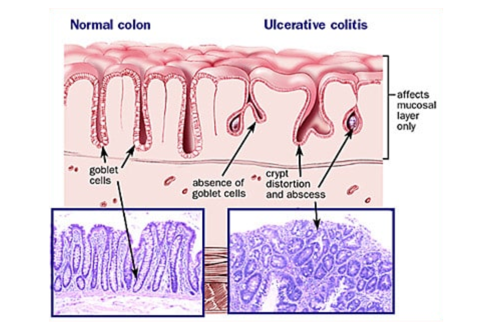 ULCERATIVE COLITIS )
