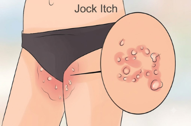 Jock Itch 